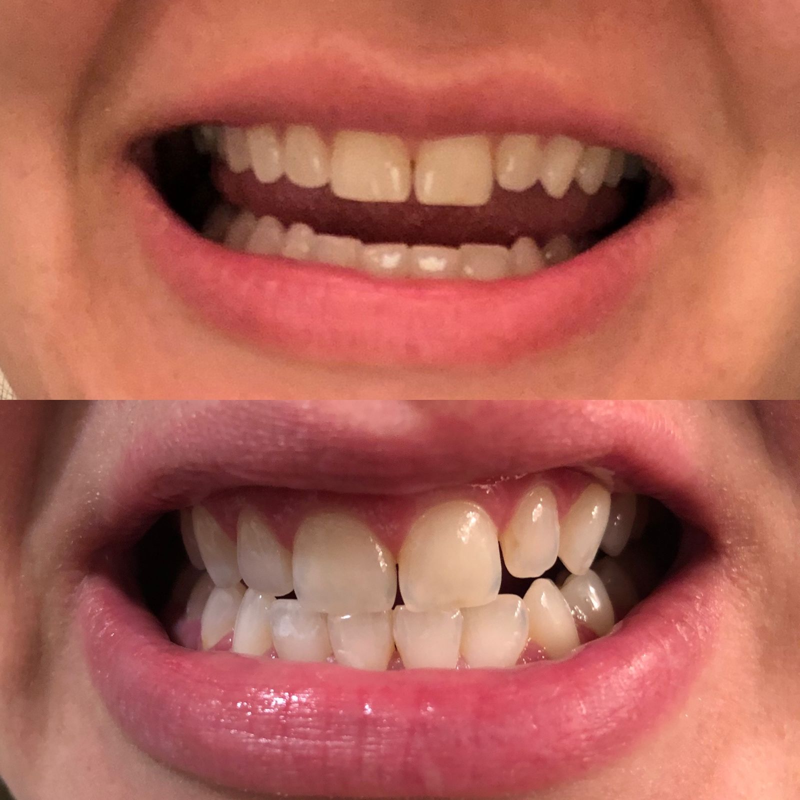 How to make teeth less sensitive after whitening