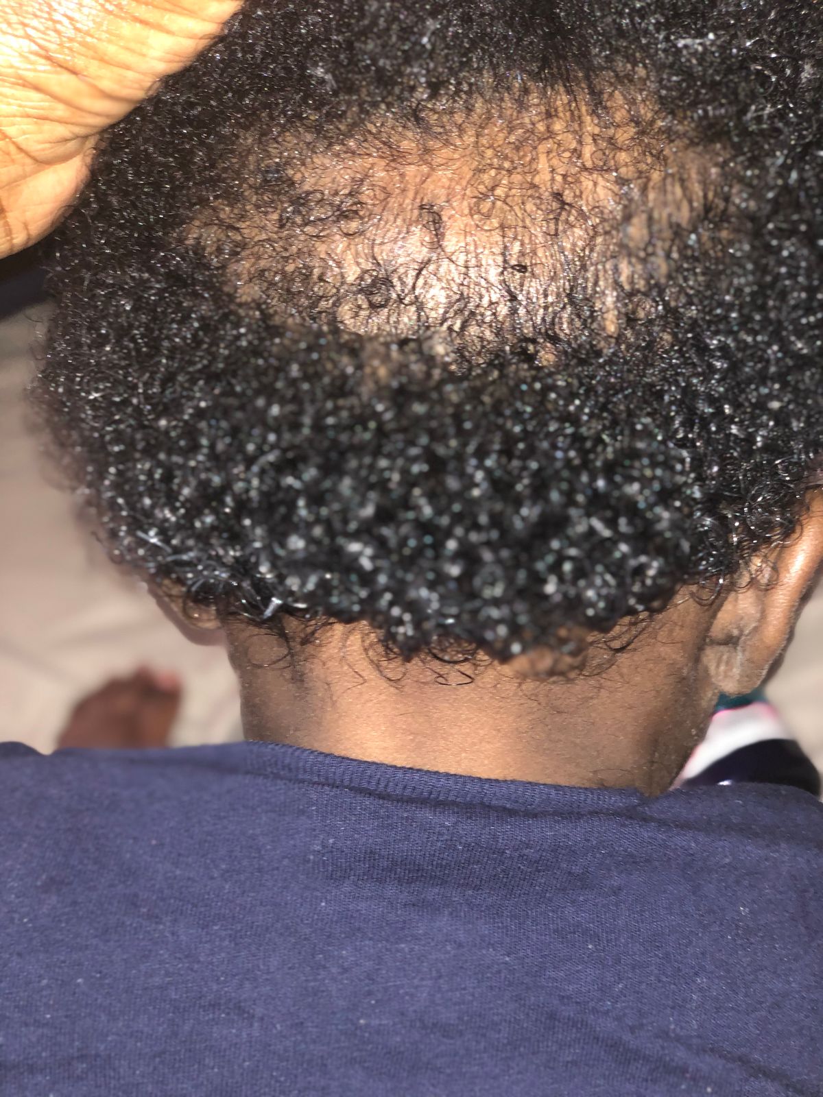 Eczema Honey Soothing Scalp Oil Eczema Honey Co