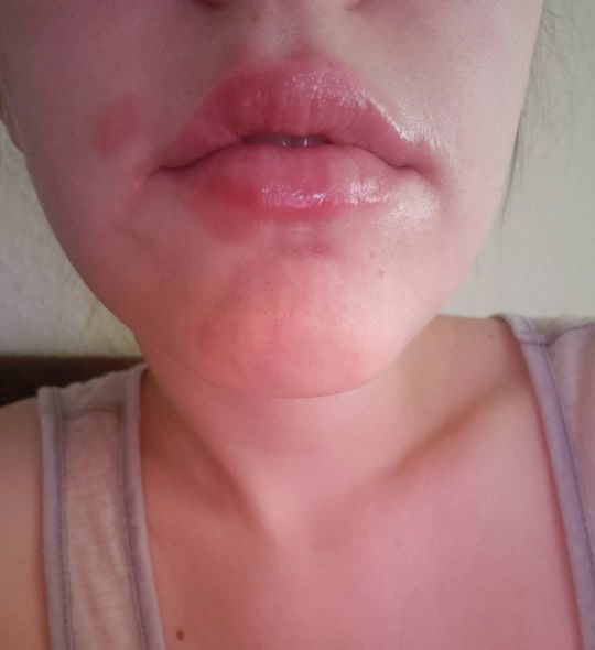 Eczema Honey Nourishing Lip Balm Eczema Honey Co