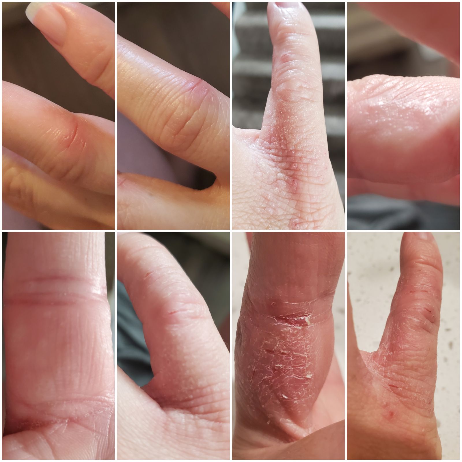 Eczema Honey Oatmeal Hand Cream Eczema Honey Co