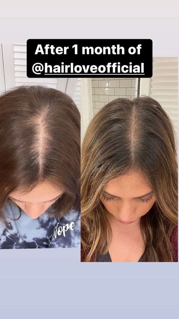 Top 53+ pcos hair loss regrowth success best in.eteachers