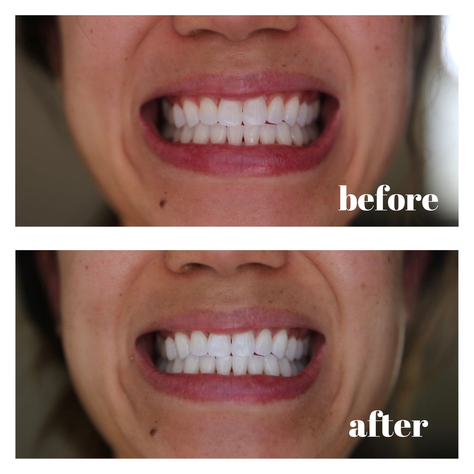Teeth Whitening Strips Before And After